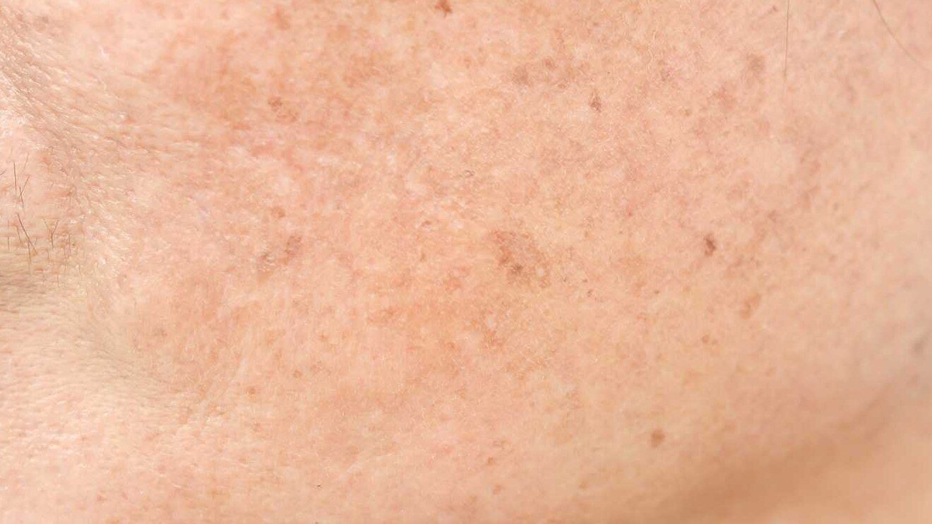 Keratosis